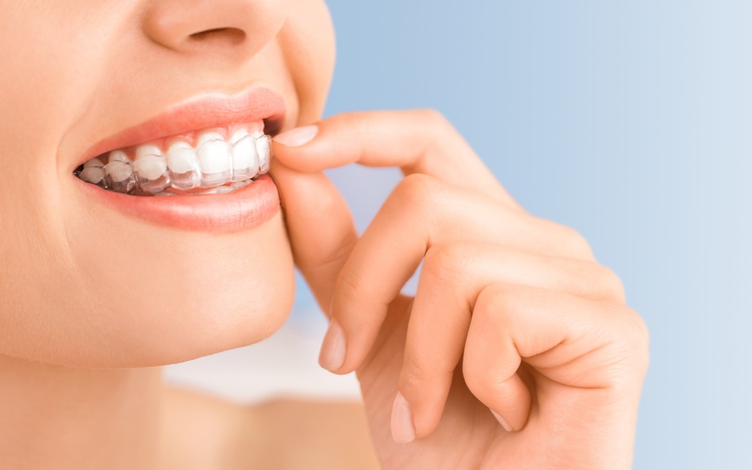 Como funciona la ortodoncia invisible: beneficios, duración y precios