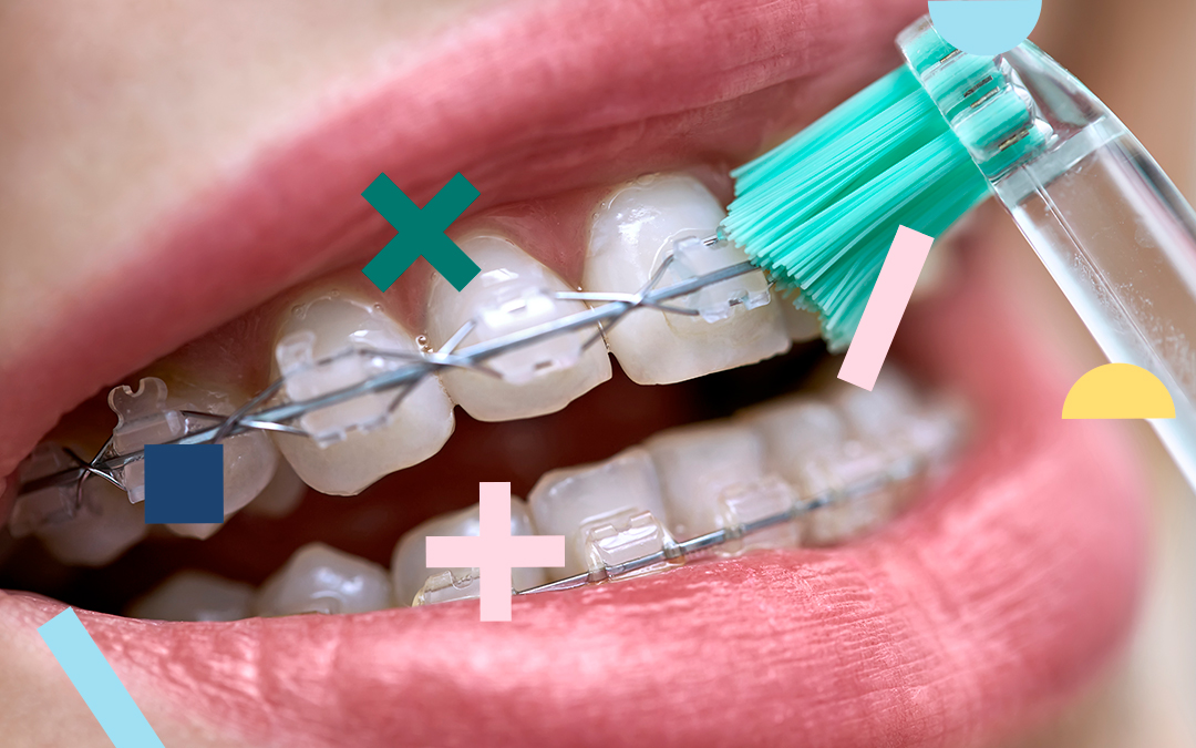Brossage des dents avec un appareil dentaire  Comment dois-je me brosser  les dents ? - KIN